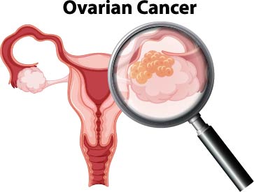 Cancer de ovario. Información de utilidad.