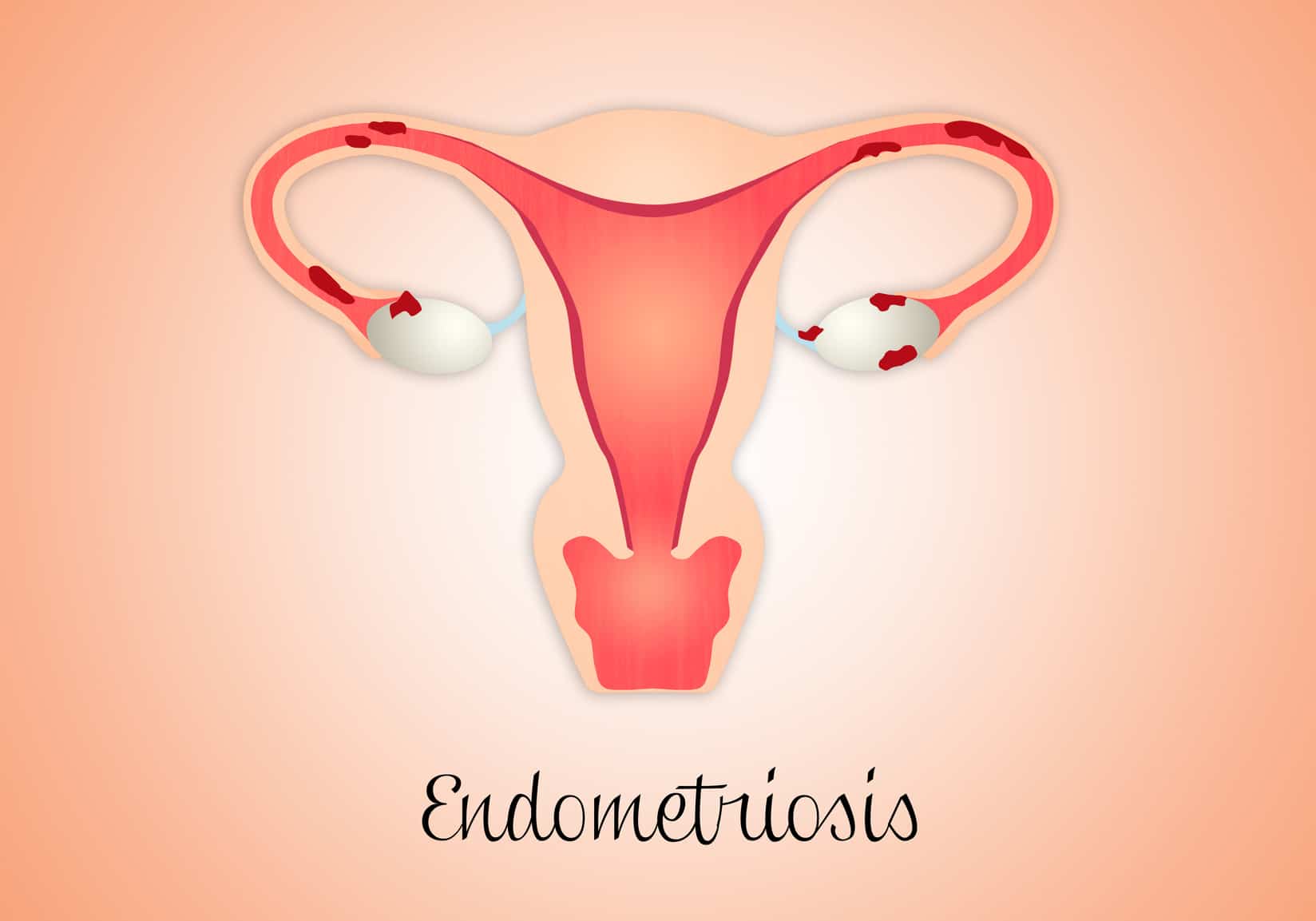 El A,B,C de la endometriosis