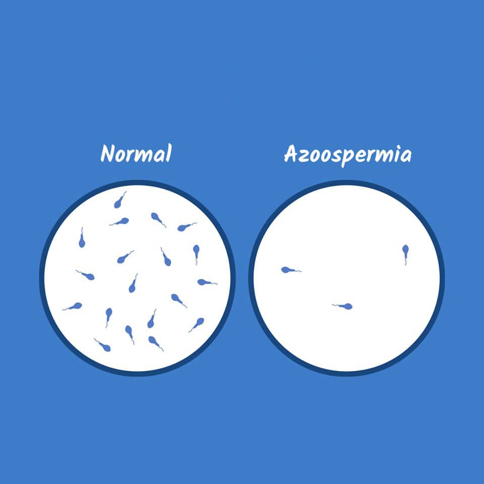 Azoospermia. Que y porqué