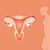 endometrioma y fertilidad