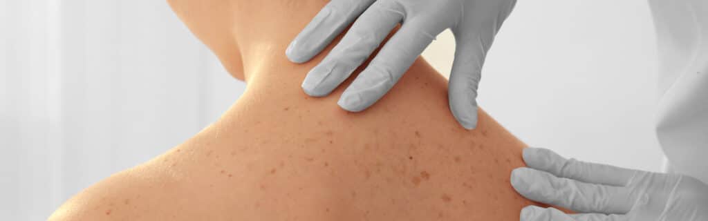 Dermatología en Murcia